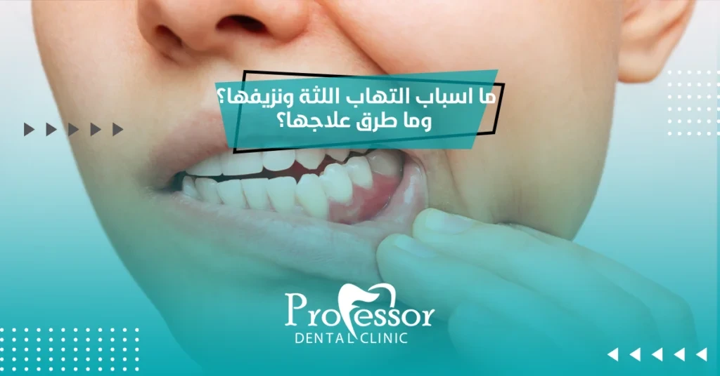 اسباب التهاب اللثة