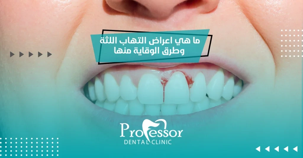اعراض التهاب اللثة