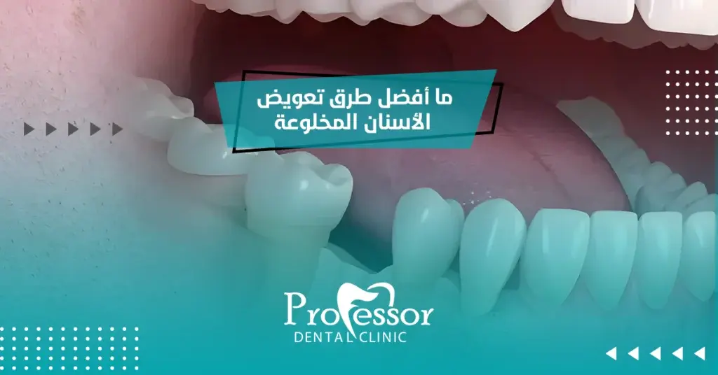 تعويض الأسنان المخلوعة