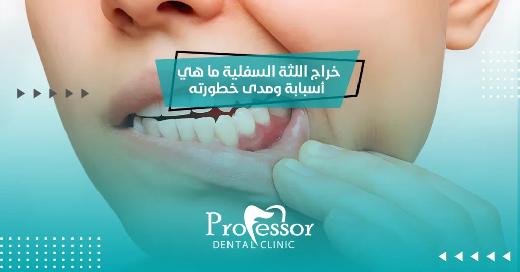 خراج اللثة السفلية