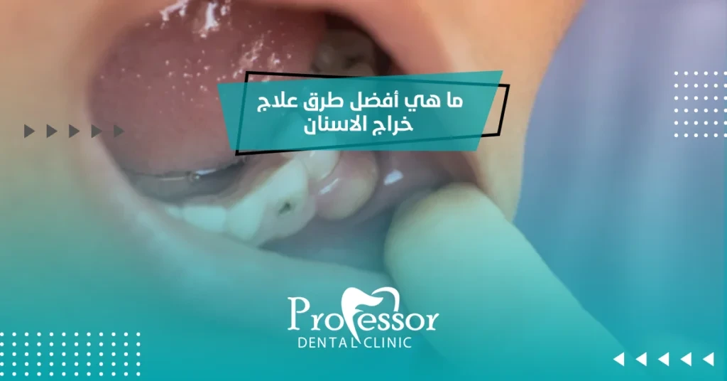علاج خراج الاسنان
