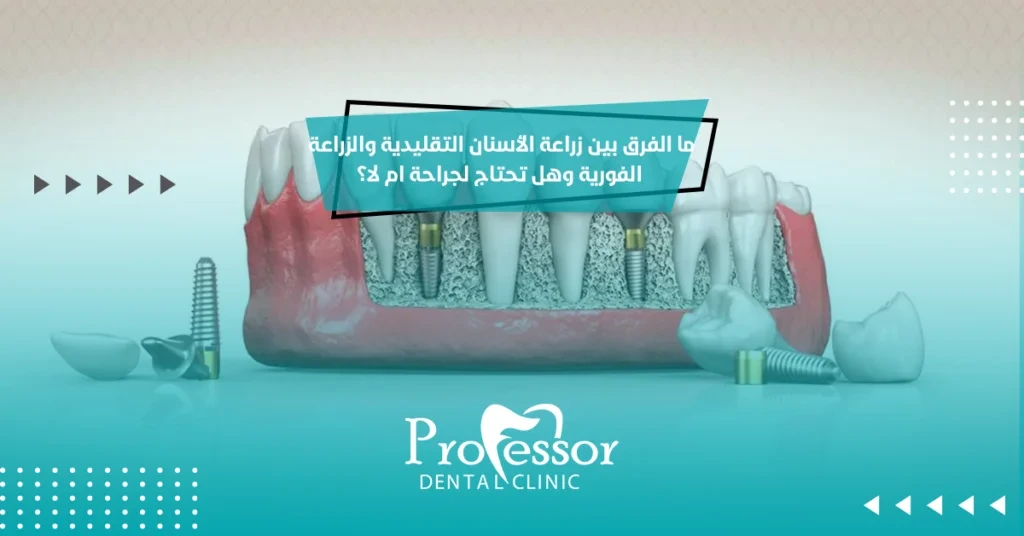 ما الفرق بين زراعة الأسنان التقليدية والزراعة الفورية وهل تحتاج لجراحة ام لا؟