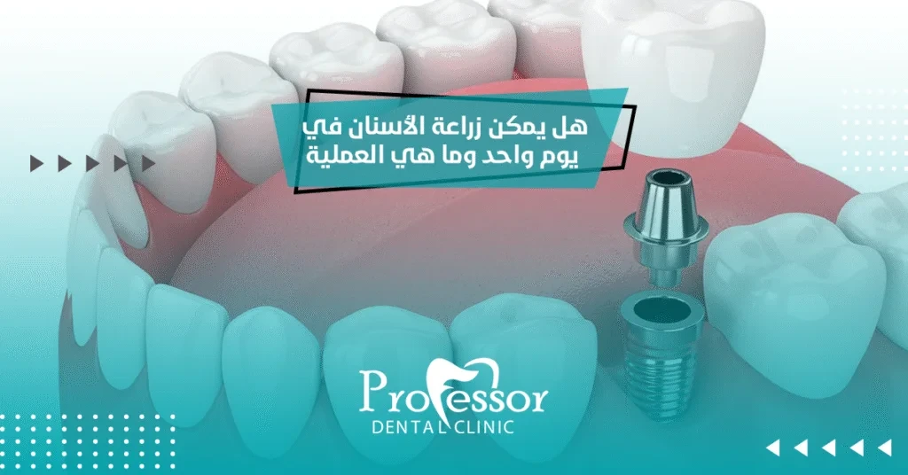 هل يمكن زراعة الأسنان في يوم واحد وما هي العملية