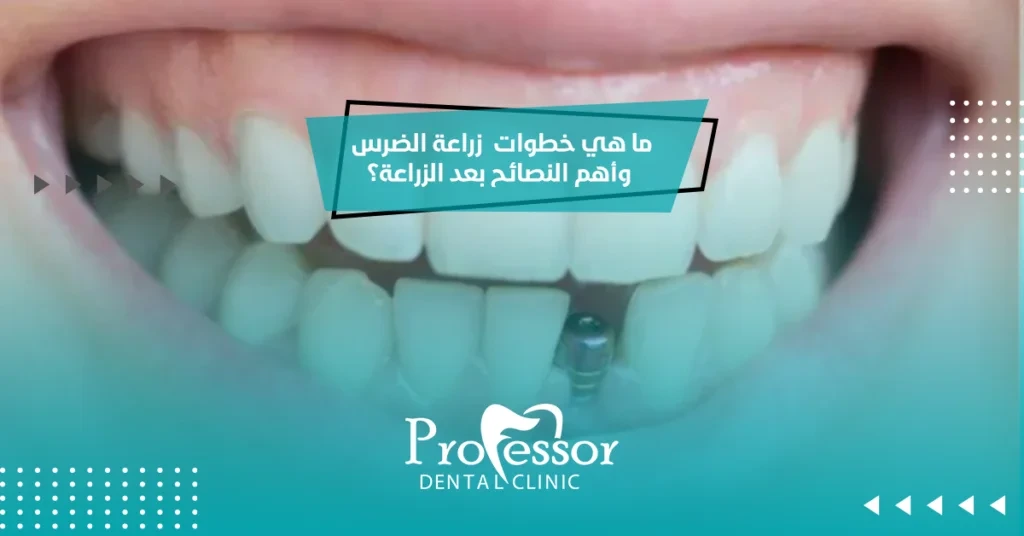 ما هي خطوات زراعة الضرس وأهم النصائح بعد الزراعة؟