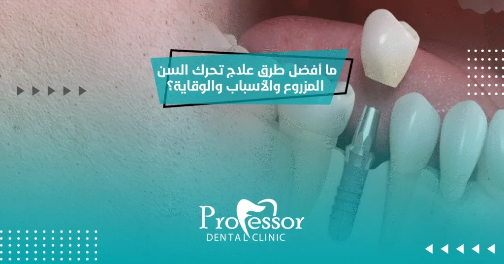 ما أفضل طرق علاج تحرك السن المزروع والأسباب والوقاية؟
