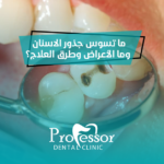 تسوس جذور الاسنان