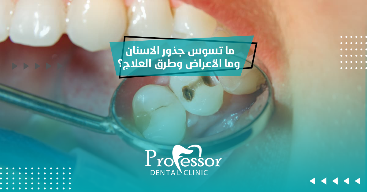 تسوس جذور الاسنان