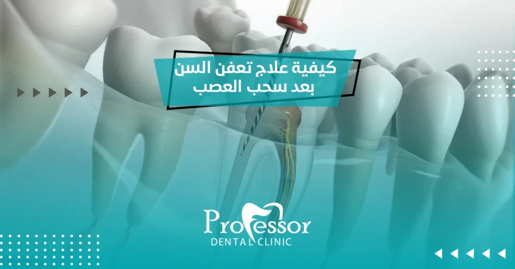 كيفية علاج تعفن السن بعد سحب العصب