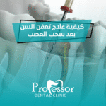 تعفن السن بعد سحب العصب