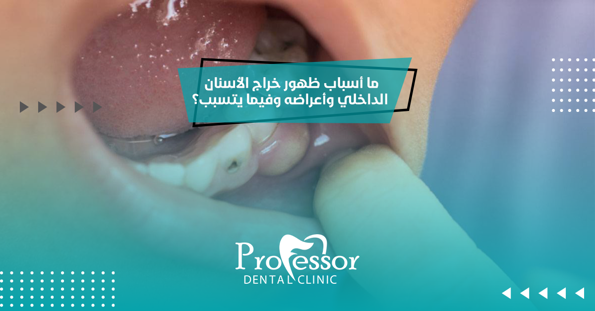 ما أسباب ظهور خراج الأسنان الداخلي وأعراضه وفيما يتسبب؟