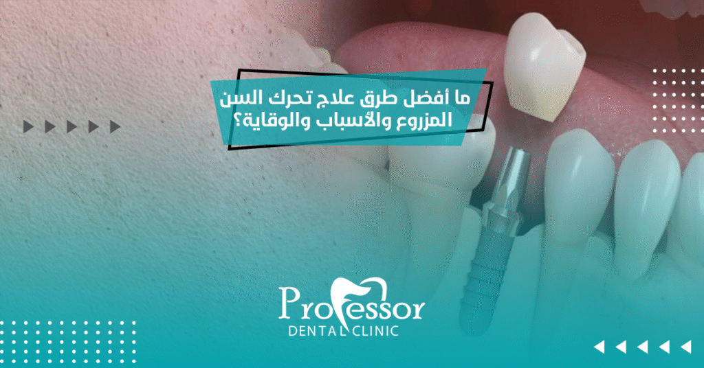 علاج تحرك السن المزروع
