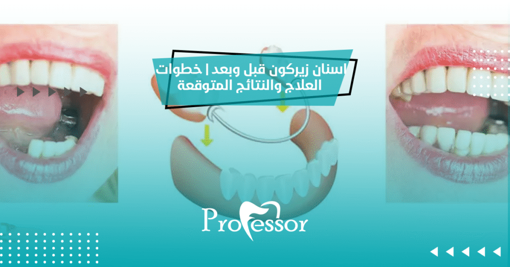 اسنان زيركون قبل وبعد