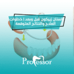 اسنان زيركون قبل وبعد