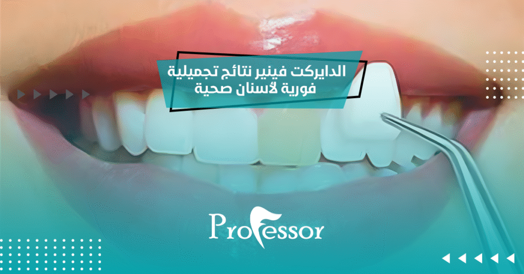 الدايركت فينير