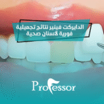 الدايركت فينير