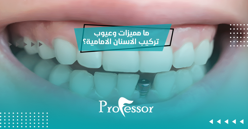 تركيب الاسنان الامامية