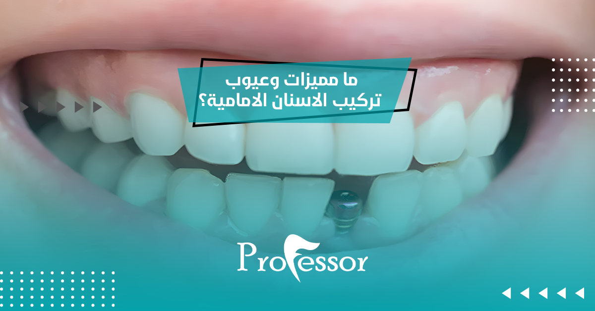 ما مميزات وعيوب تركيب الاسنان الامامية؟
