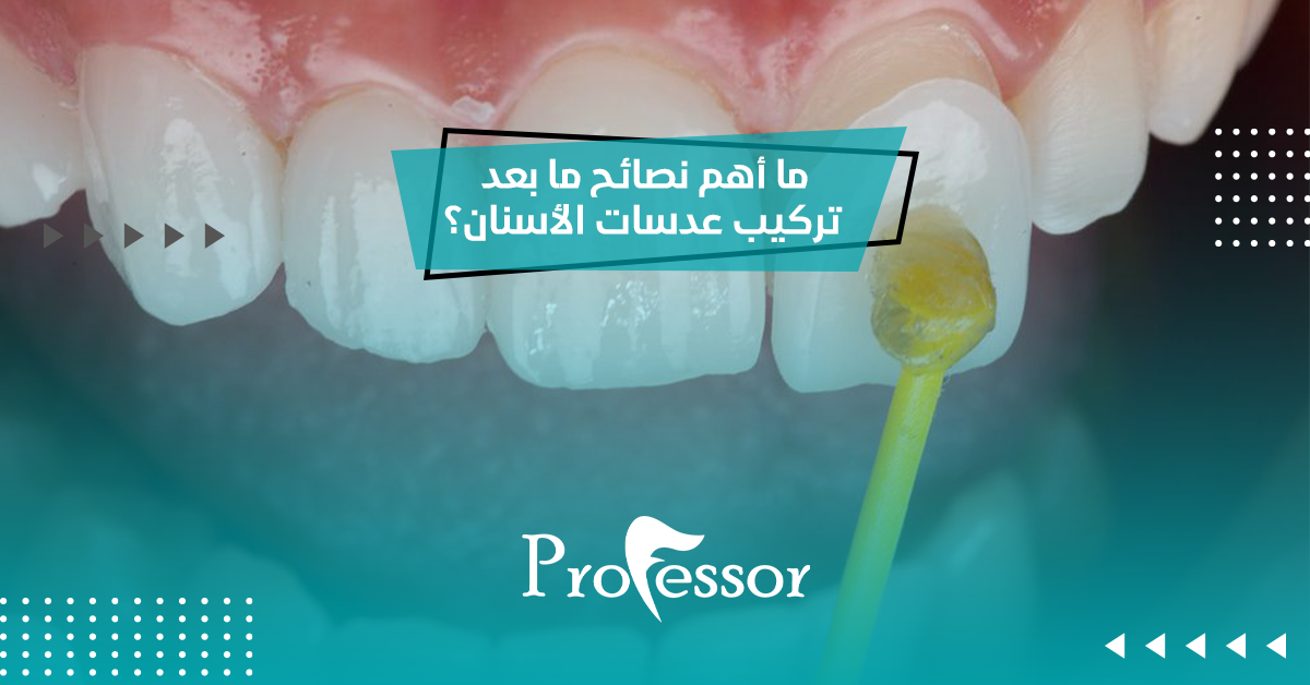 ما أهم نصائح ما بعد تركيب عدسات الاسنان؟