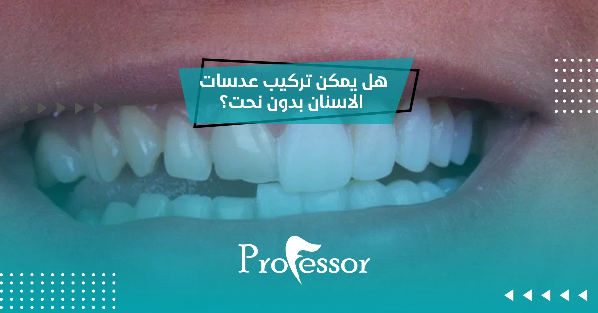 هل يمكن تركيب عدسات الاسنان بدون نحت؟