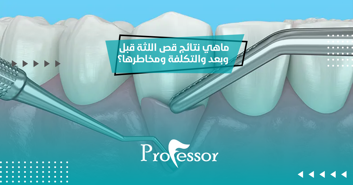 قص اللثة قبل وبعد​