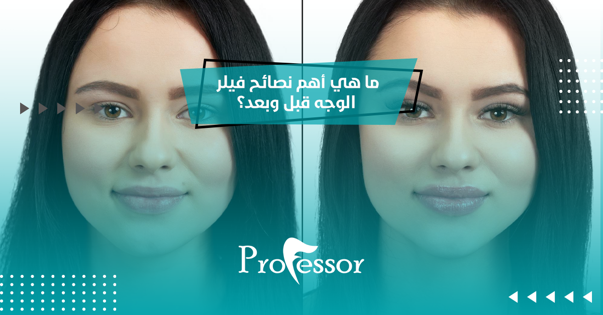 فيلر الوجه قبل وبعد