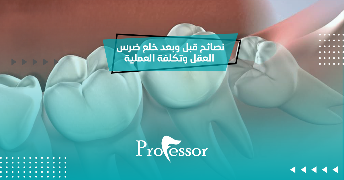 نصائح قبل وبعد خلع ضرس العقل وتكلفة العملية