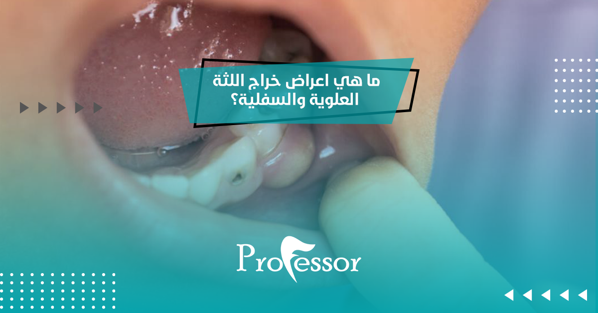 ما هي اعراض خراج اللثة العلوية والسفلية؟