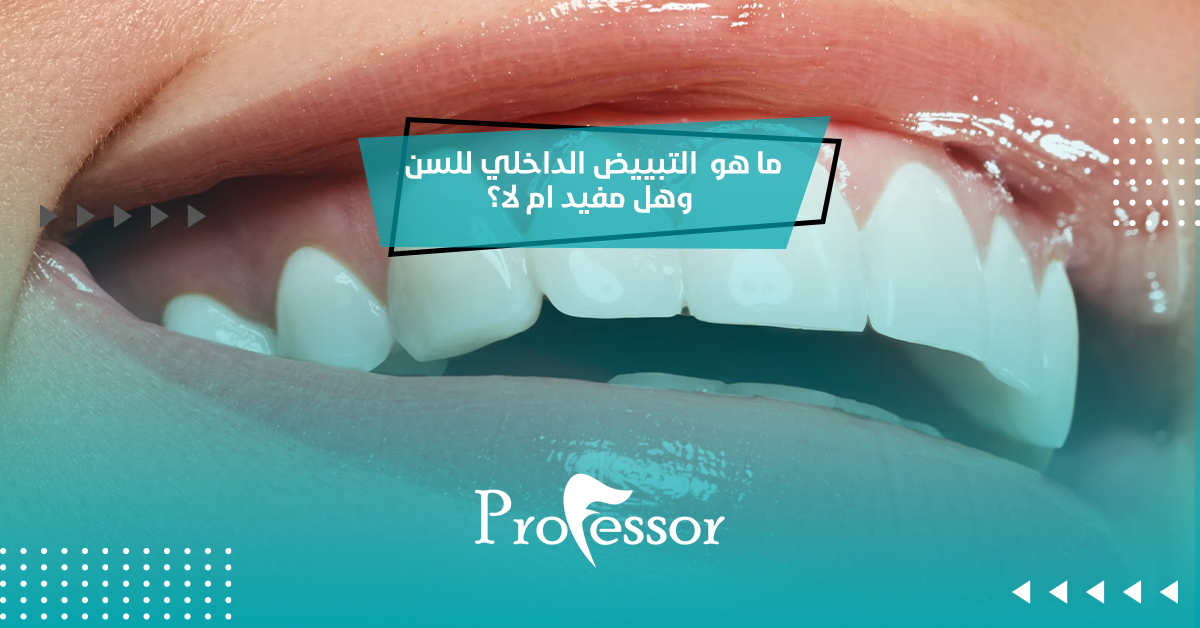 التبييض الداخلي للسن