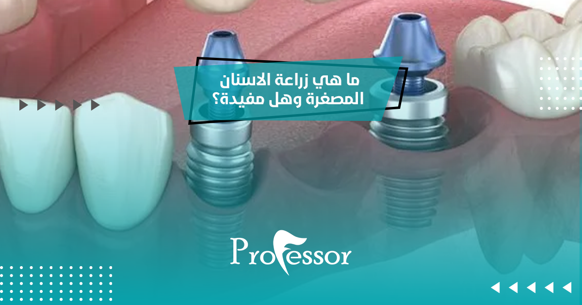 زراعة الاسنان المصغرة