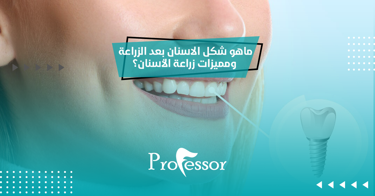ماهو شكل الاسنان بعد الزراعة ومميزات زراعة الأسنان؟