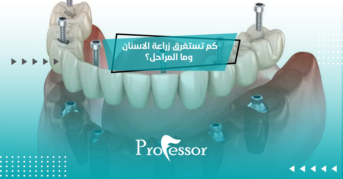 كم تستغرق زراعة الاسنان
