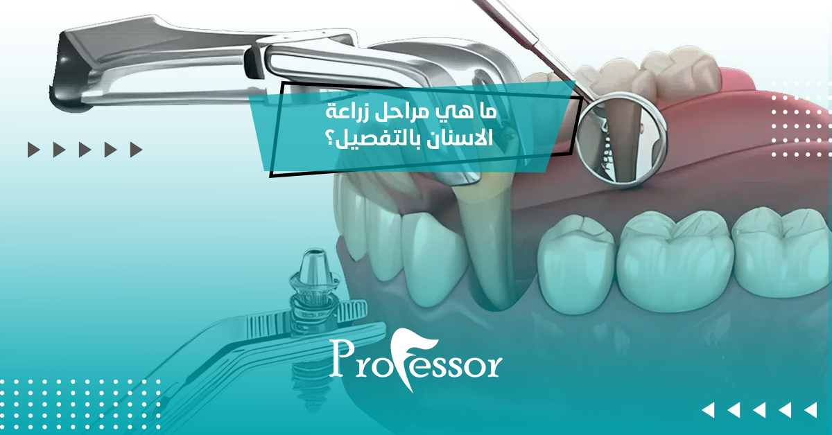 ما هي مراحل زراعة الاسنان بالتفصيل