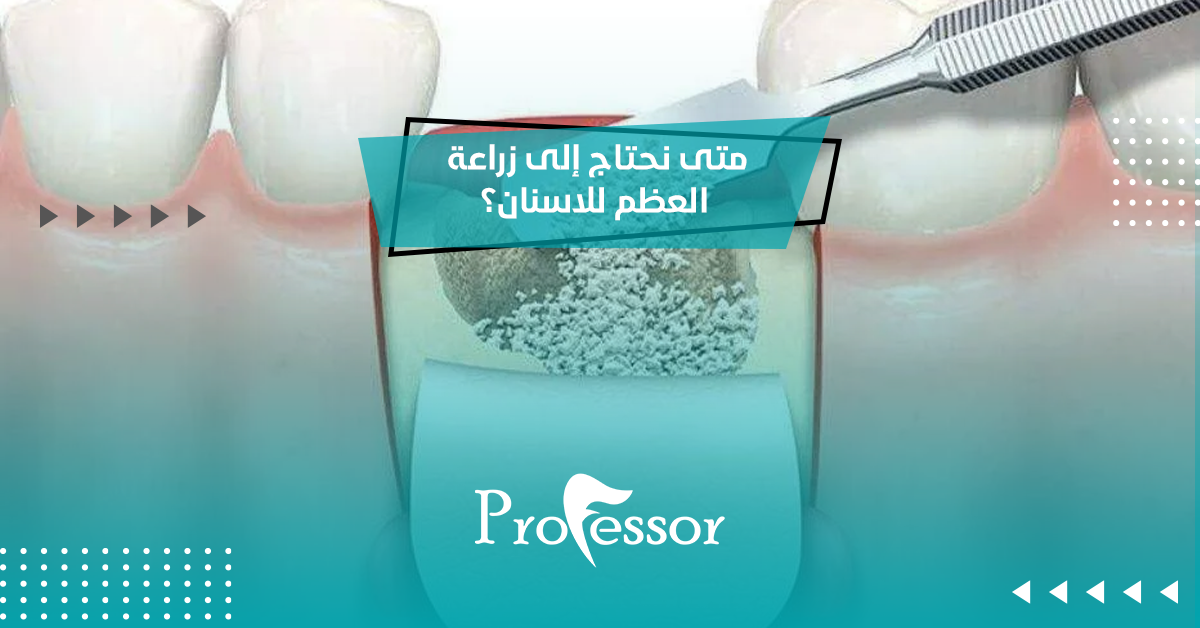 زراعة العظم للاسنان