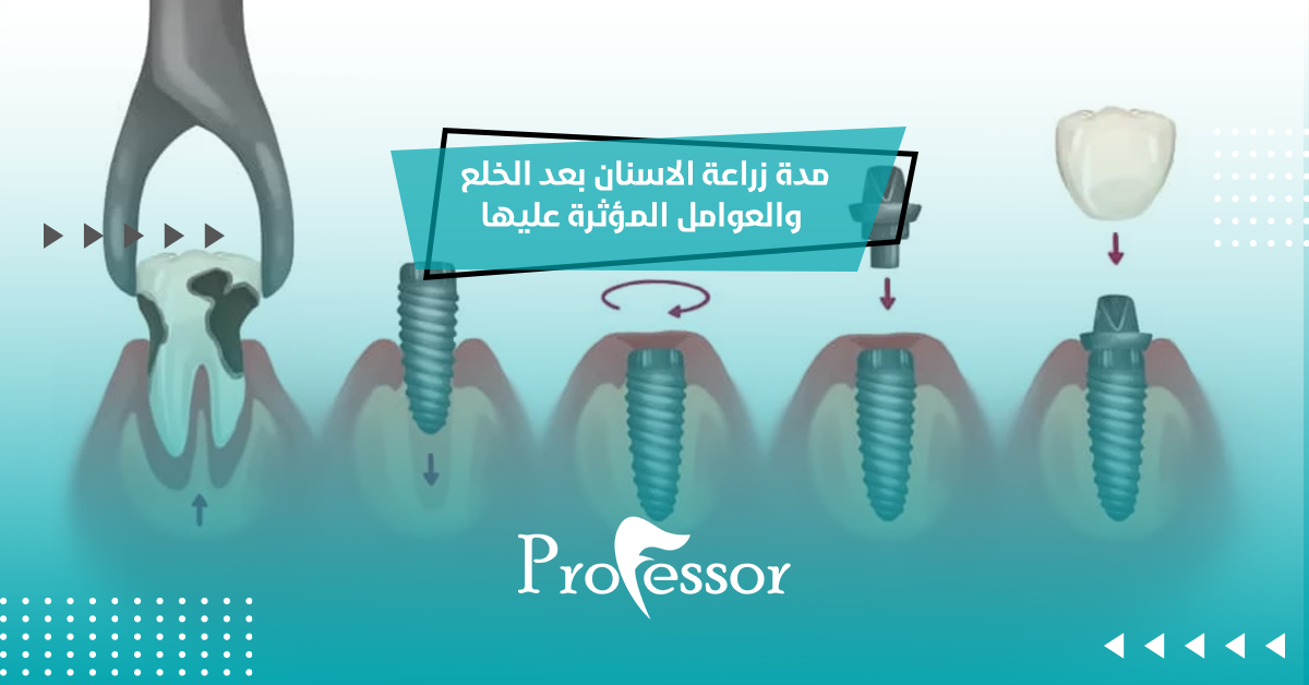 مدة زراعة الاسنان بعد الخلع