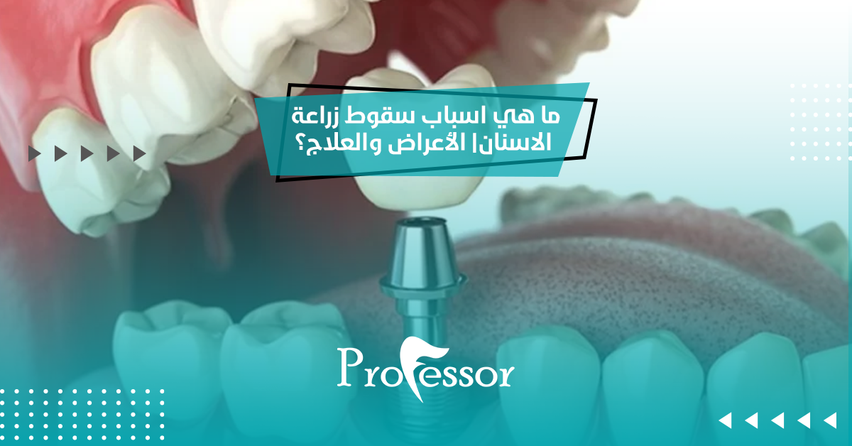 ما هي اسباب سقوط زراعة الاسنان| الأعراض والعلاج؟