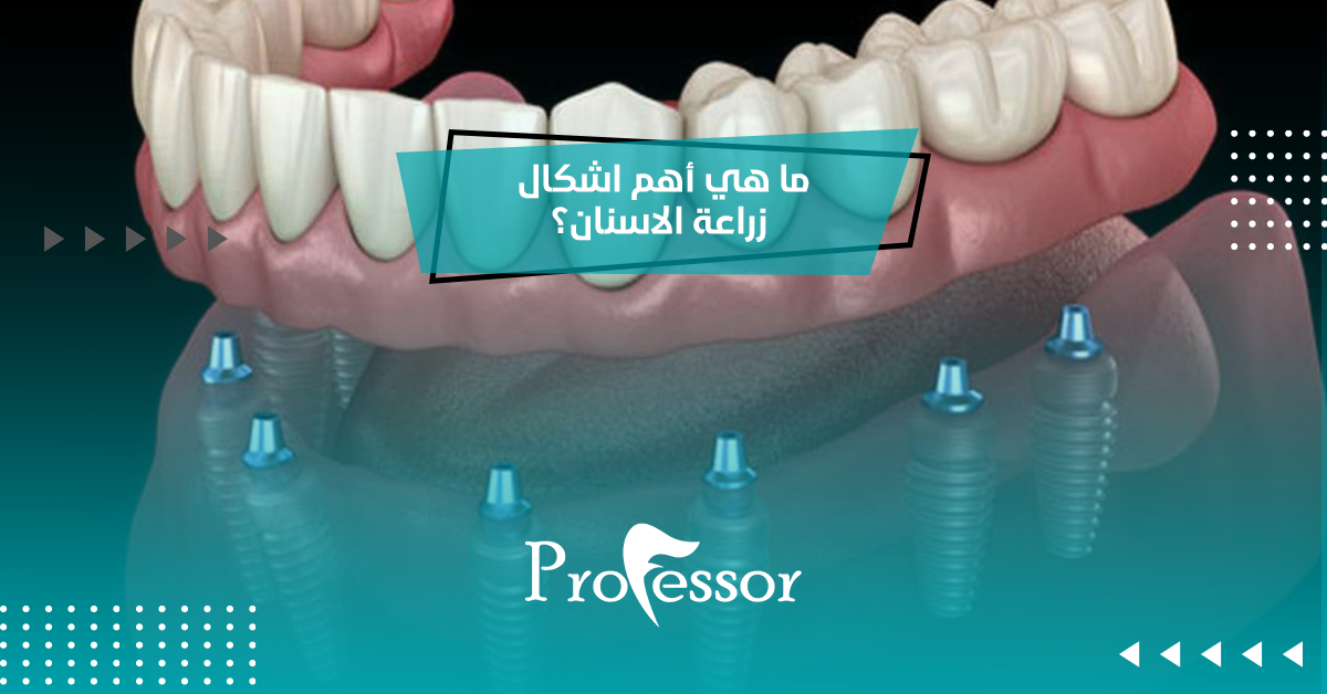 ما هي أهم اشكال زراعة الاسنان؟