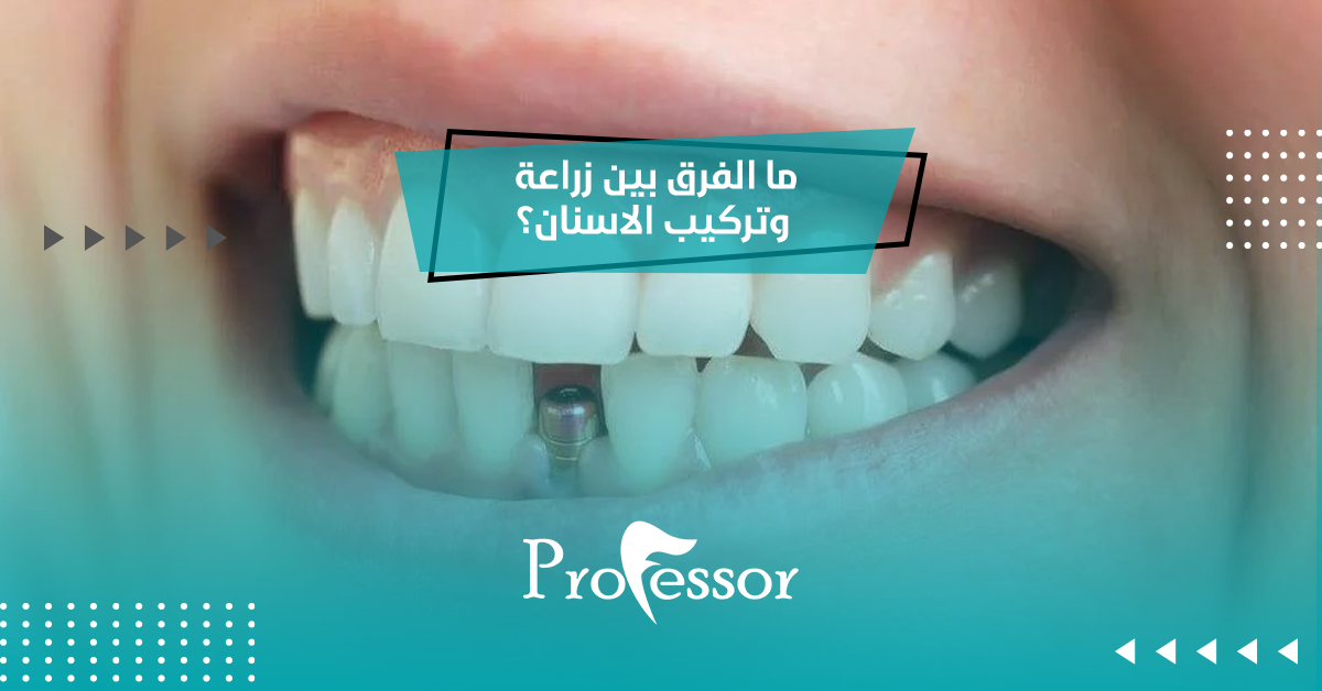 ما الفرق بين زراعة وتركيب الاسنان؟