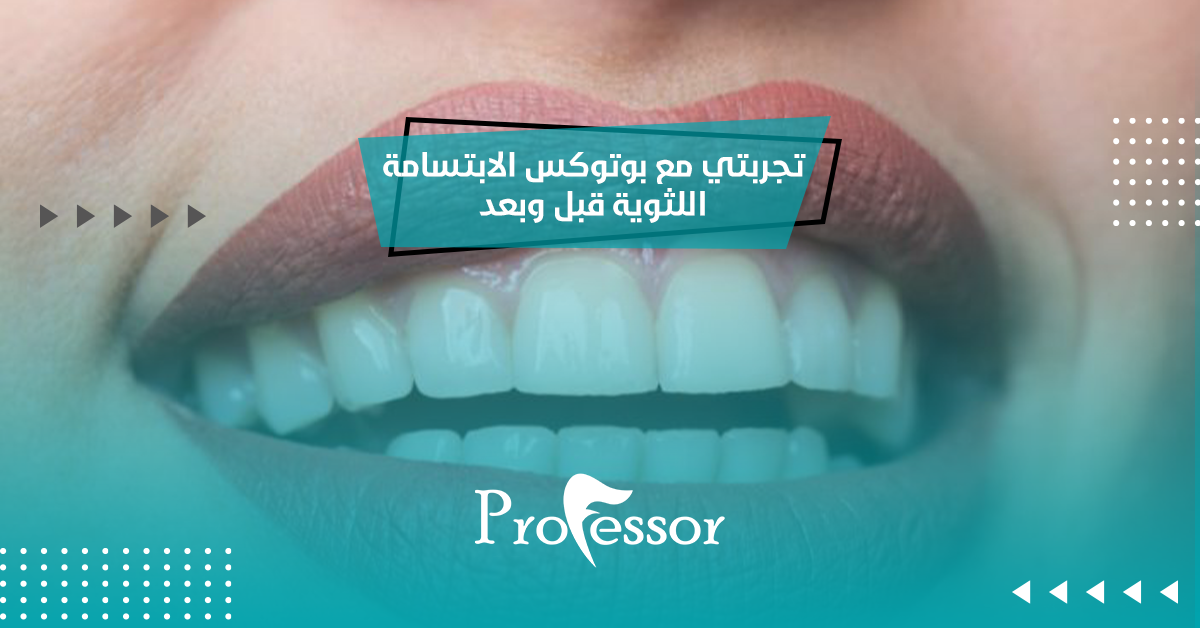 تجربتي مع بوتوكس الابتسامة اللثوية قبل وبعد