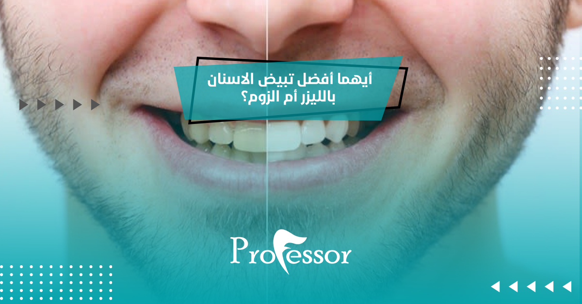 أيهما أفضل تبيض الاسنان بالليزر أم الزوم؟