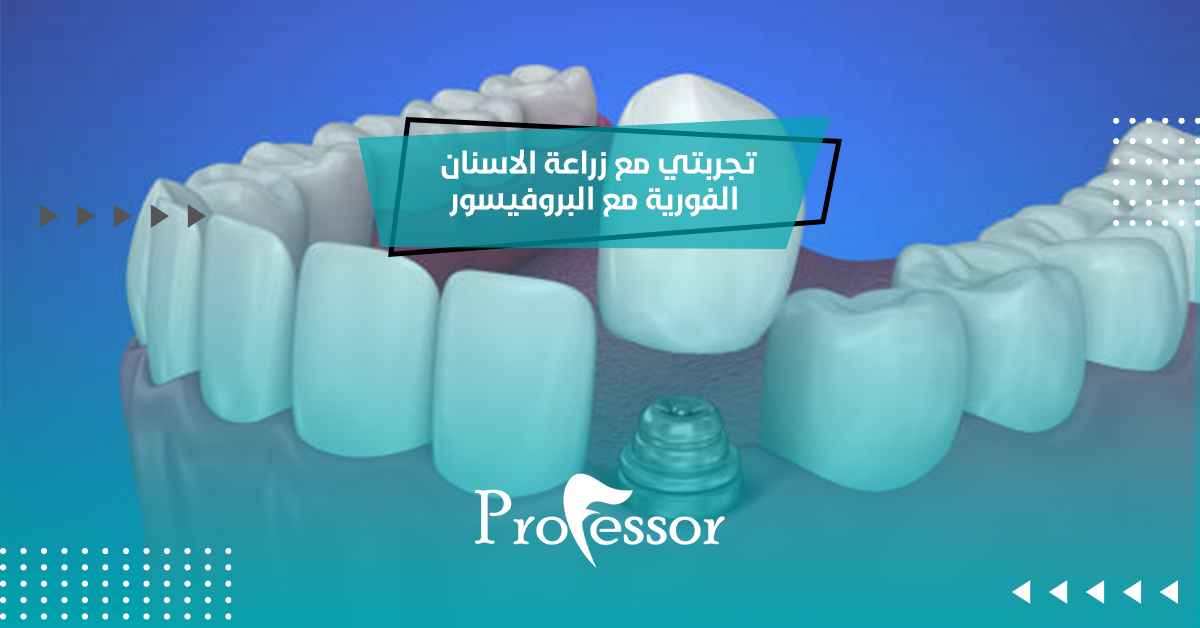 تجربتي مع زراعة الاسنان الفورية مع البروفيسور