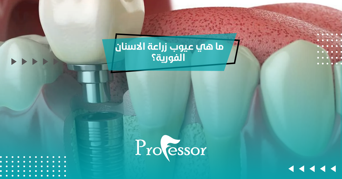 ما هي عيوب زراعة الاسنان الفورية؟