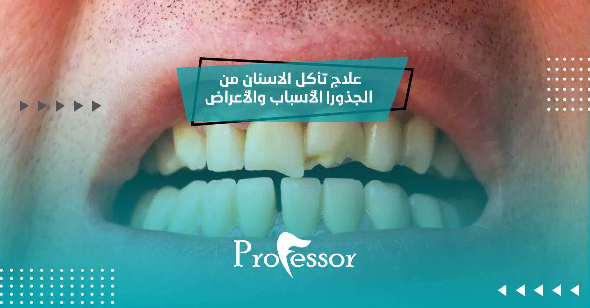 علاج تأكل الاسنان