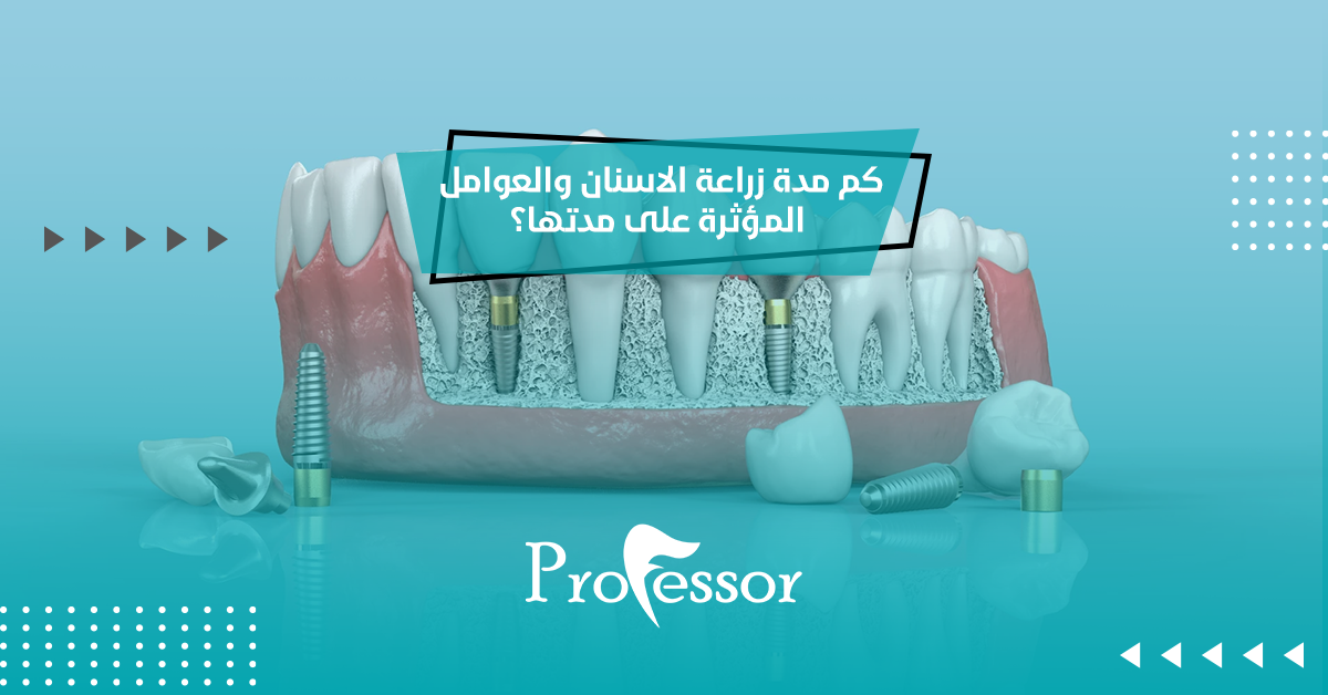 كم مدة زراعة الاسنان والعوامل المؤثرة على مدتها؟
